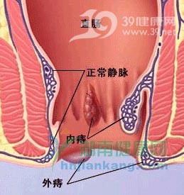 警惕！加班男人易多发痔疮