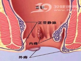 警惕！加班男人易多发痔疮